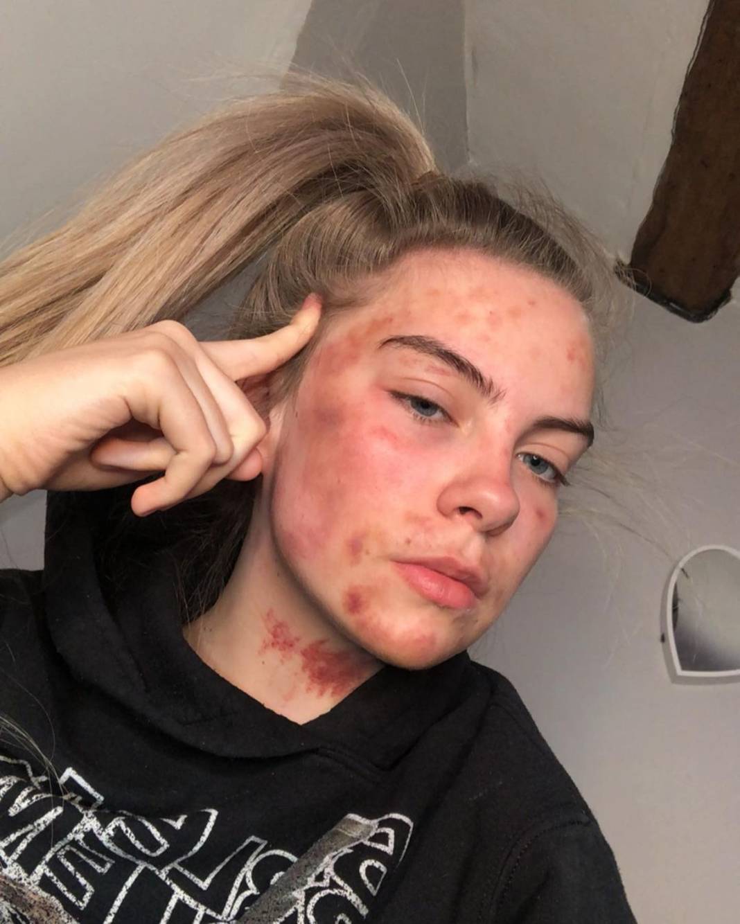 Basit bir uçuk zannetti, korkunç hastalığa yakalandı! Doktorlar bile teşhis koyamadı 15